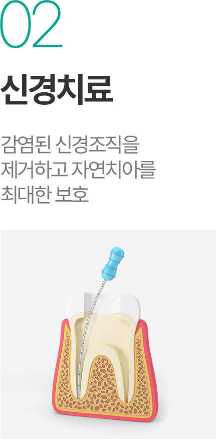 신경치료 - 감염된 신경조직 제거와 자연치아 보호 신경치료 - 감염된 신경조직 제거와 자연치아 보호