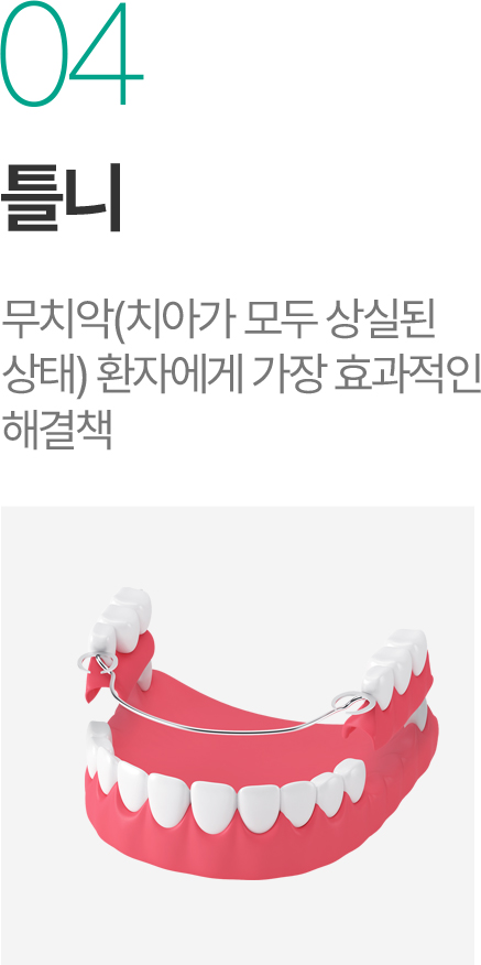 틀니 - 무치악 환자를 위한 효율적인 해결책 틀니 - 무치악 환자를 위한 효율적인 해결책