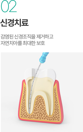 신경치료 - 감염된 신경조직 제거와 자연치아 보호 신경치료 - 감염된 신경조직 제거와 자연치아 보호