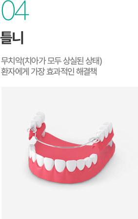 틀니 - 무치악 환자를 위한 효율적인 해결책 틀니 - 무치악 환자를 위한 효율적인 해결책