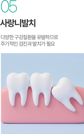 사랑니발치 - 구강질환 예방을 위한 검진과 발치 사랑니발치 - 구강질환 예방을 위한 검진과 발치